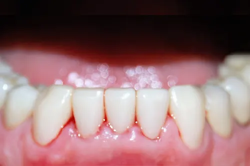 Teeth after porcelain crowns were placed