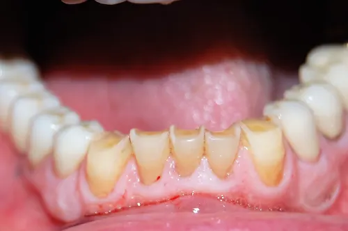 Teeth before porcelain crowns were placed
