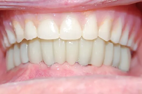 Full mouth dental implants after treatment