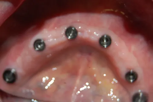 Full mouth dental implants before the prosthesis was fitted