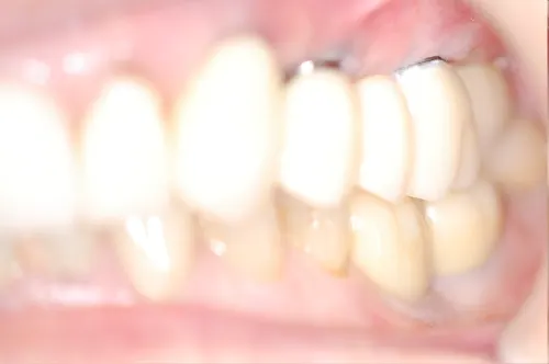 Partial mouth dental implants after crowns were placed