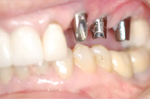 Partial mouth dental implants before crowns were placed